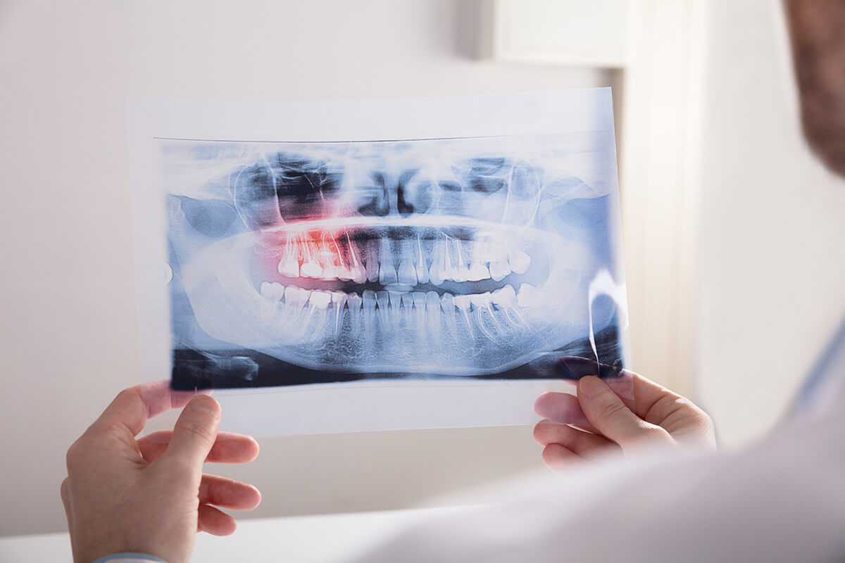 signs you need wisdom teeth removal dentist looking at xrays for signs you need wisdom teeth removal