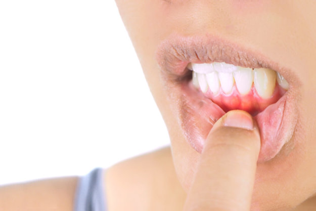 how to improve gum health woman showing her gums asking How to Improve Gum Health