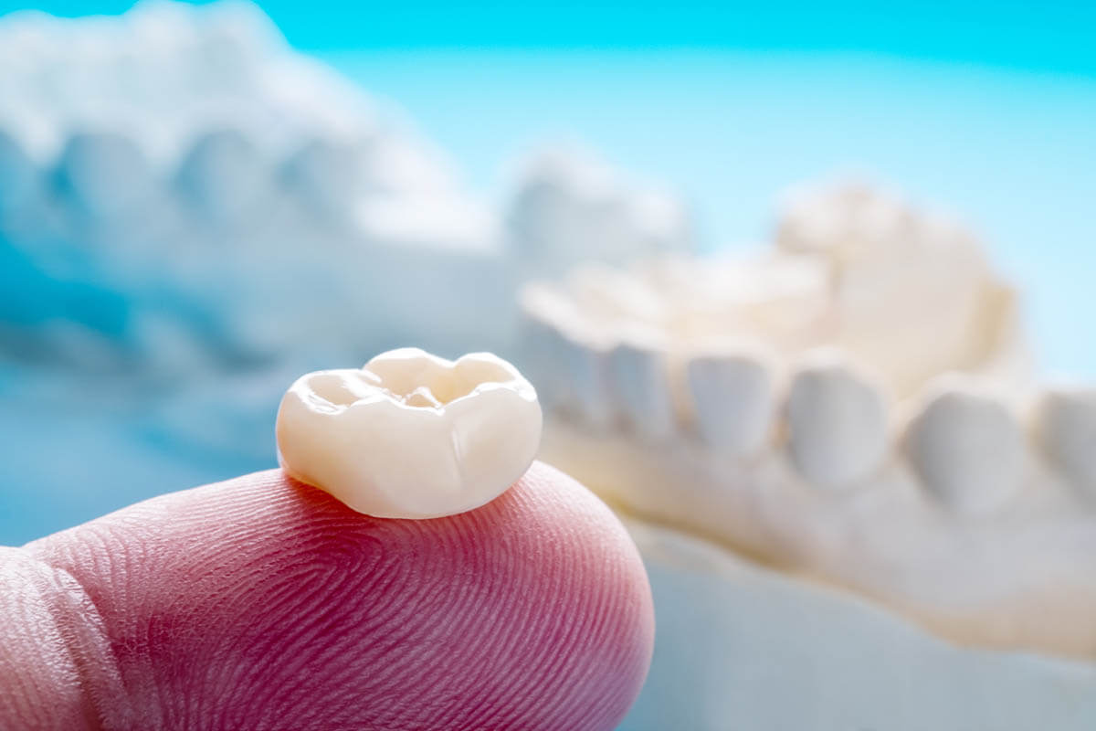 Do I Need a Dental Crown_ Example of a dental crown