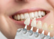 an example of veneers and dental implants