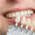 an example of veneers and dental implants