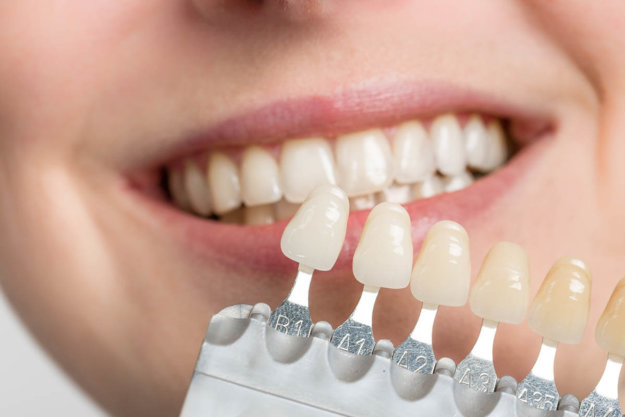 Veneers an example of veneers and dental implants