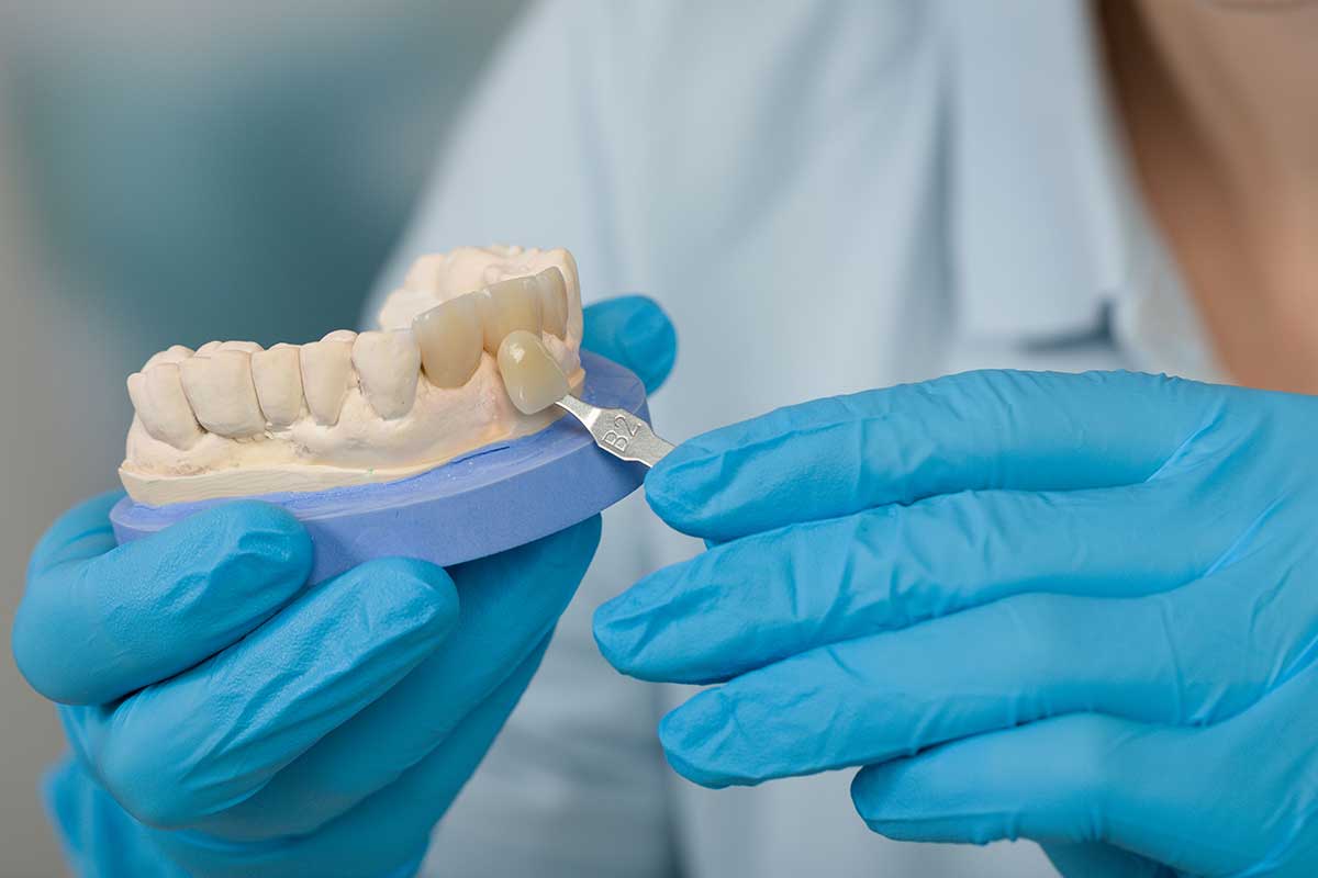 How Long do Veneers Last? Cosmetic Dentistry Maryland