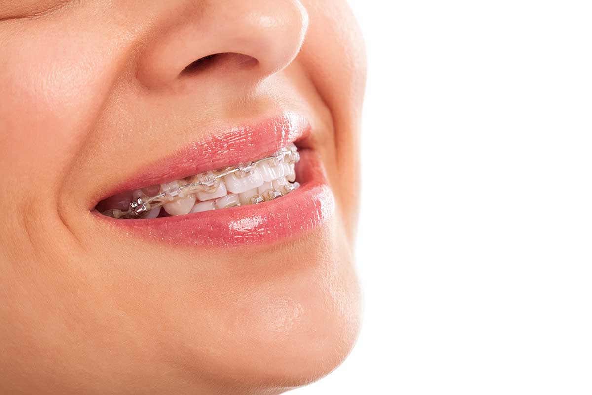 When are Braces Necessary Woman getting braces because they we necessary