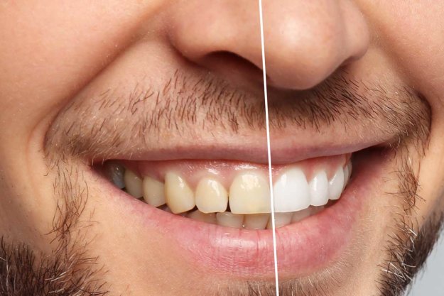 The Best Teeth Whitening Procedures before and after of teeth whitening service