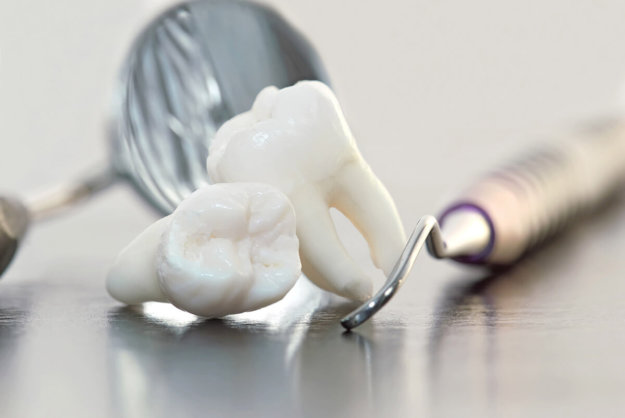 Wisdom Teeth Recovery Time picture of wisdom teeth following removal