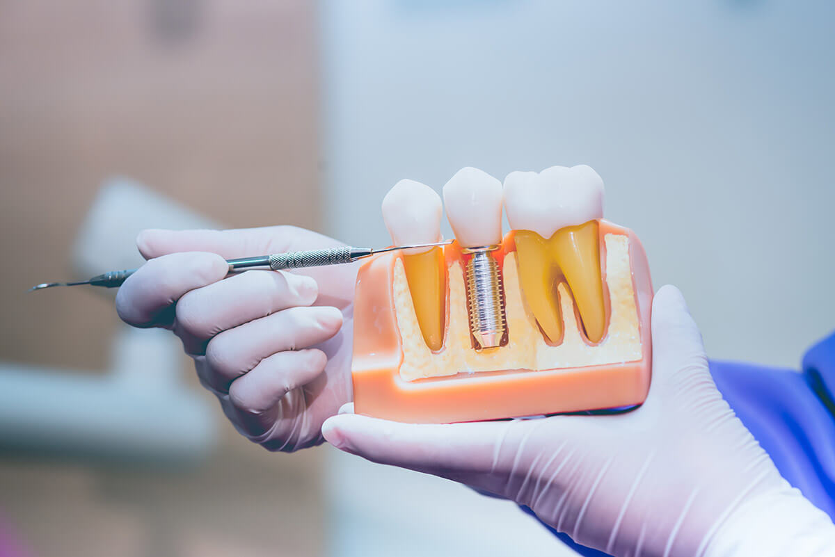 dentist showing the potential problems with a dental implant