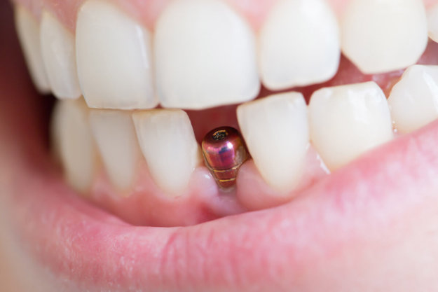 How Long Do Dental Implants Last_ dental implant that will last