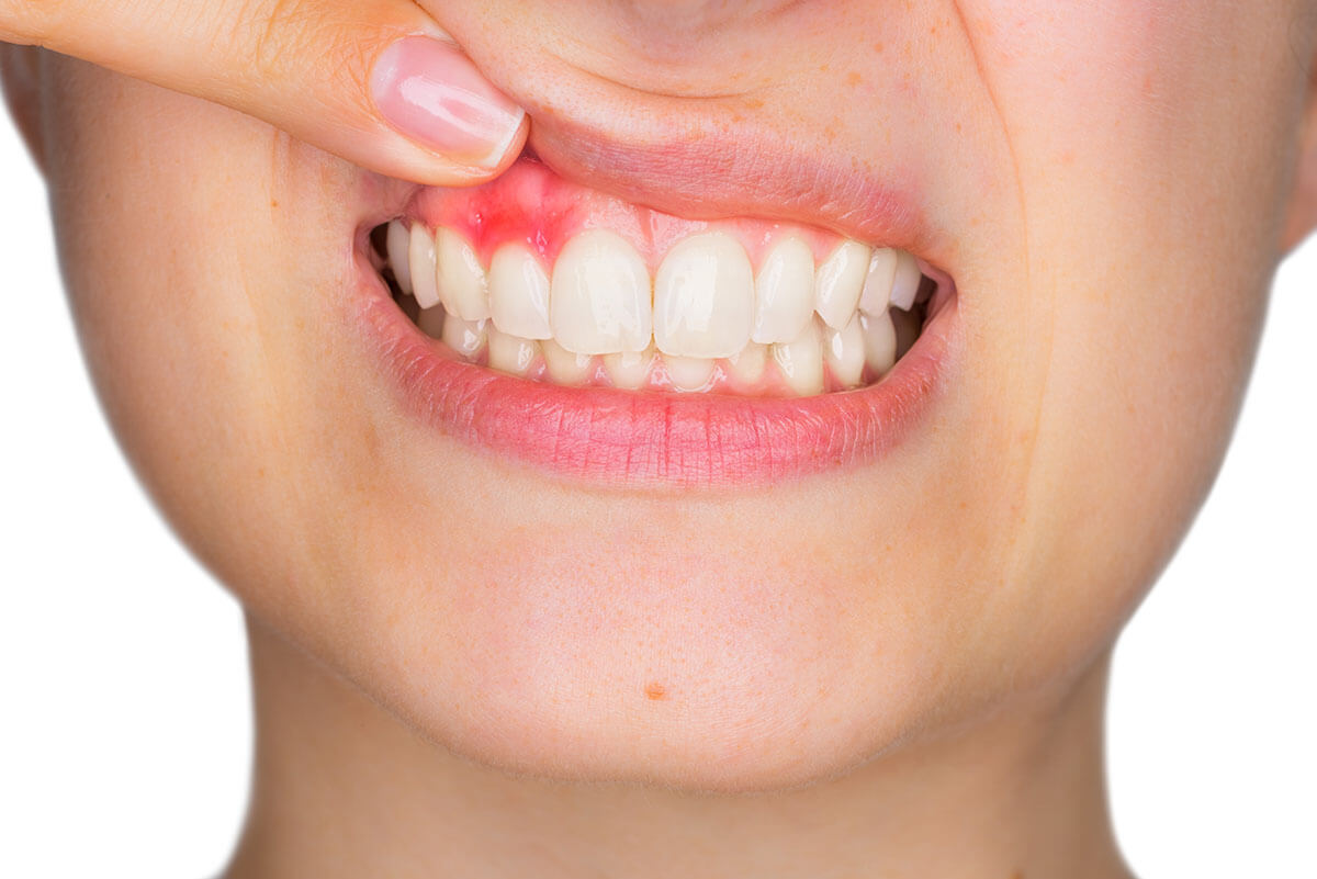 Why Are My Gums Inflamed_ person experiencing gum inflammation