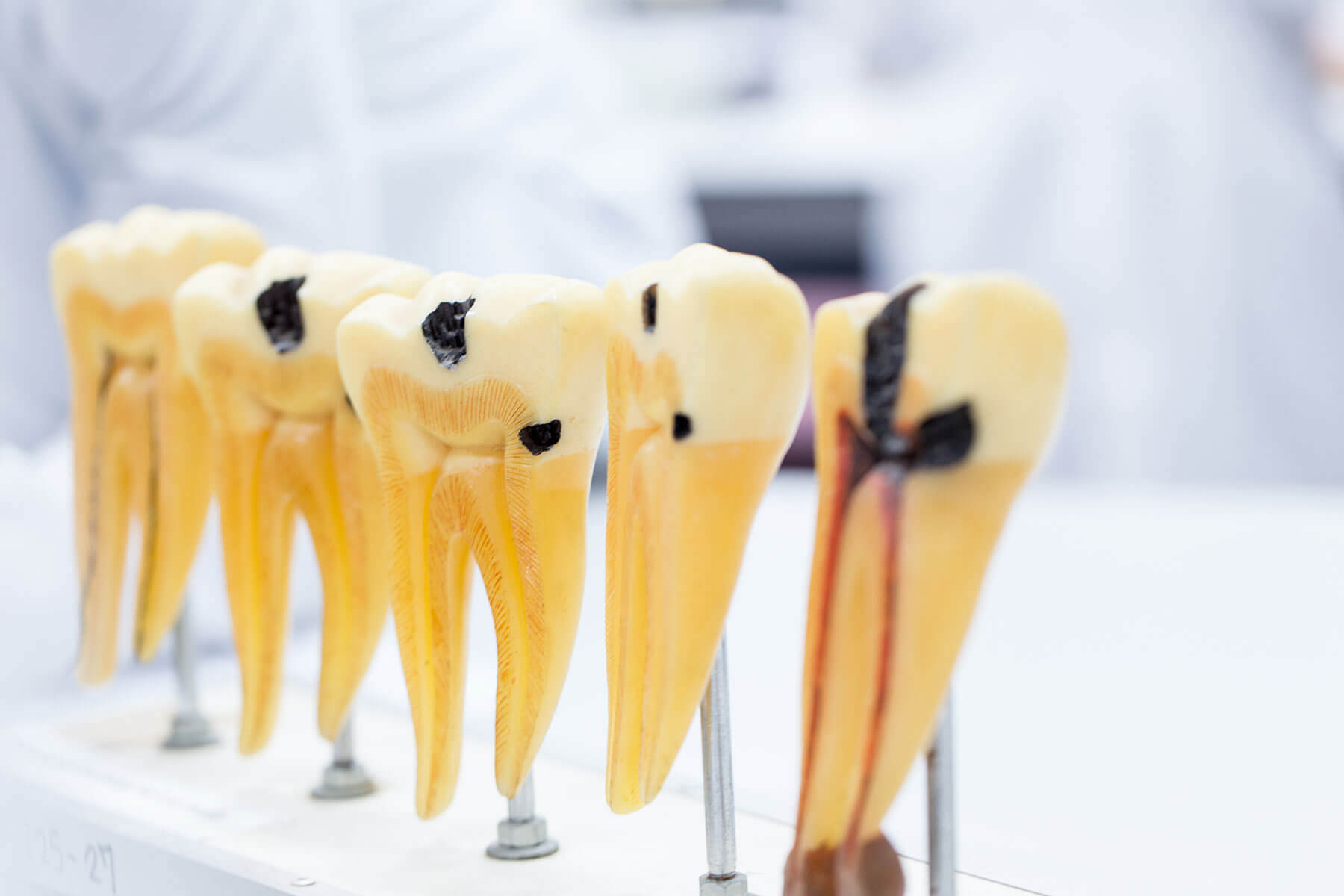 model teeth show where to find a root canal in columbia, md