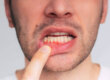 A man who needs to know how to prevent gum recession