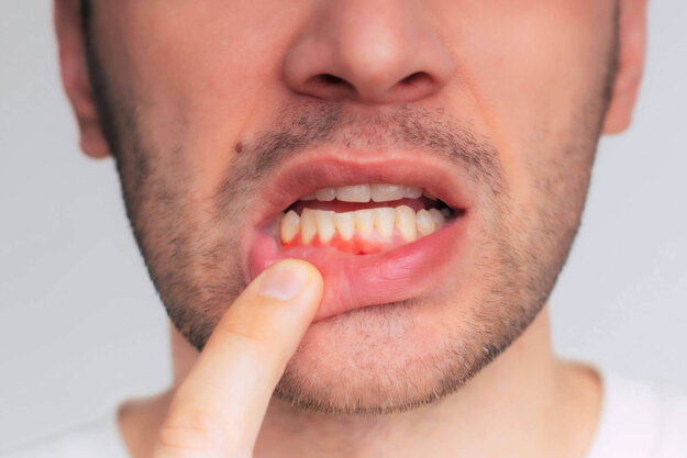 How to Prevent Gum Recession A man who needs to know how to prevent gum recession