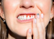 A woman showing signs of periodontal disease