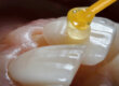 Close up of veneer on tooth